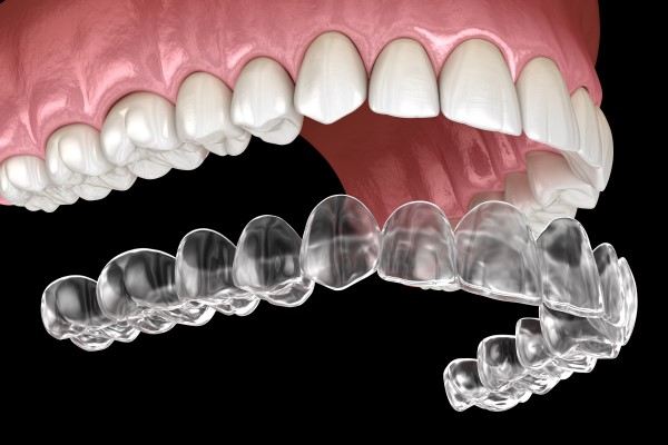 Invisible Aligners: Redefining Comfort in Dental Treatments